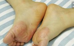 脚底牛皮癣初期症状图片-NPX0221